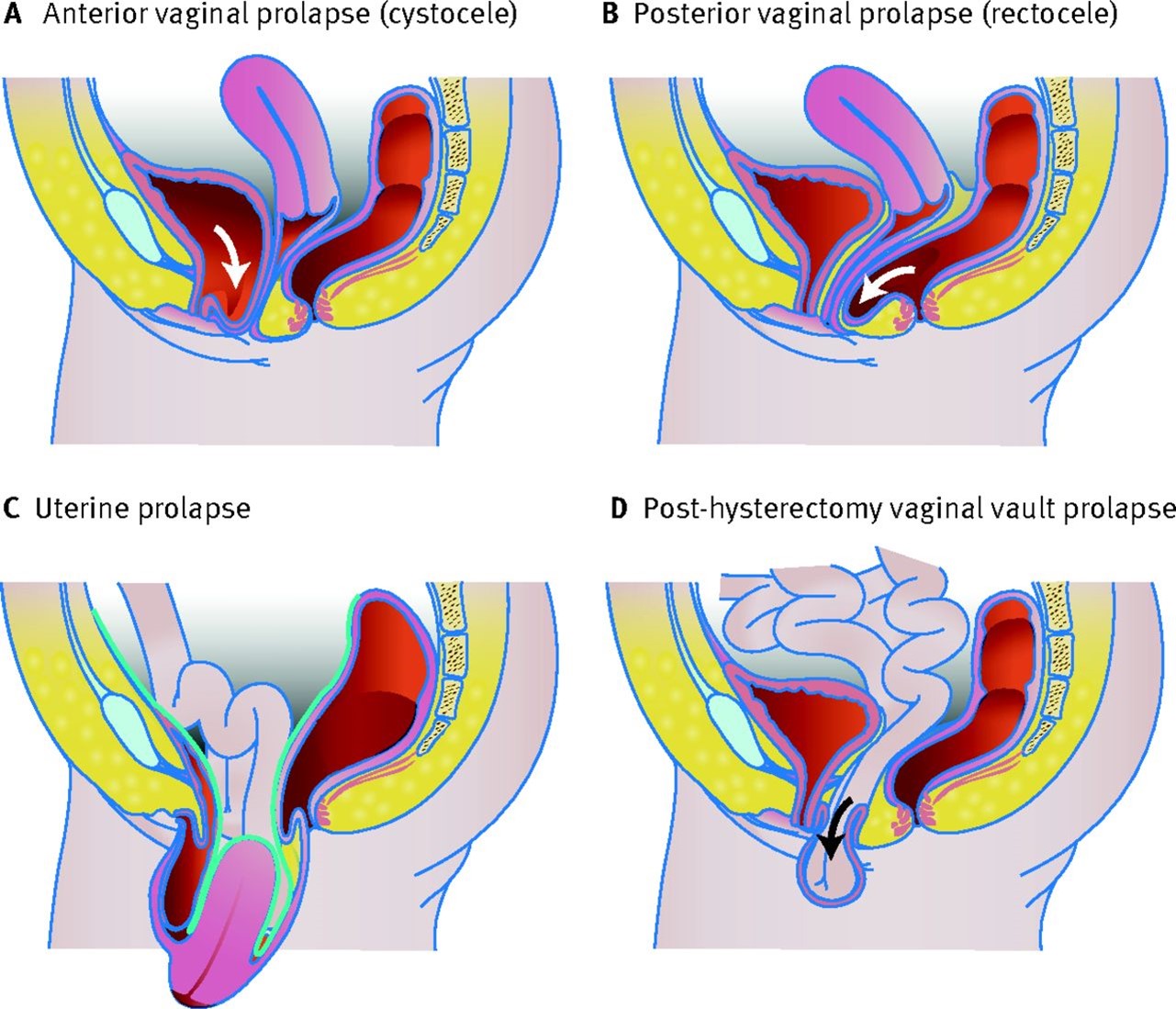 Proclusive Prolapse - Dr. Anjali Gupta