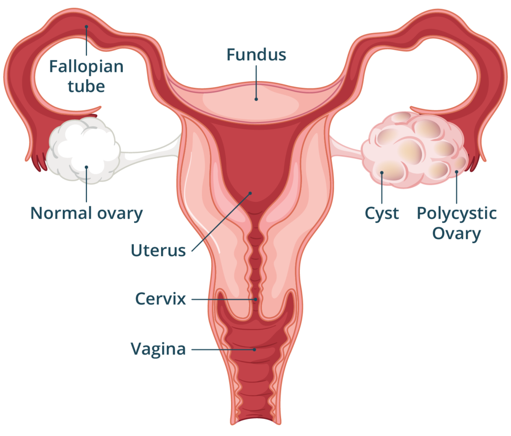 PCOS Treatment in Noida | Dr. Anjali Gupta